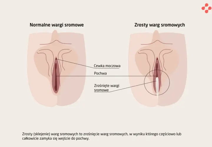 Ilustracja pokazuje, jak wygląda cipa: normalne wargi sromowe i zrośnięte wargi sromowe, z zaznaczoną cewką moczową i pochwą.