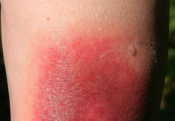 Symptome Borreliose beim Menschen: Warnzeichen, die Sie kennen sollten