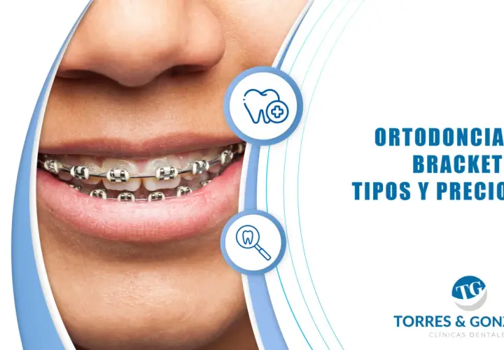 Sonrisa con ortodoncia. Descubre cuánto cuesta la ortodoncia y los tipos de brackets disponibles en Torres & González.