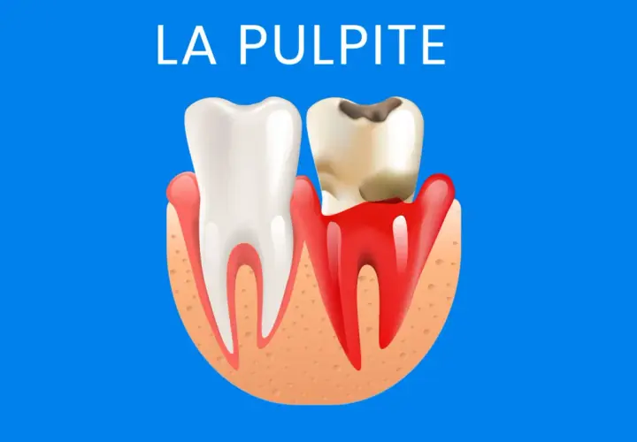 Dente sano e dente cariato con gengive infiammate. Illustrazione sulla pulpite, suggerendo la necessità di rimedi per il nervo dente infiammato.