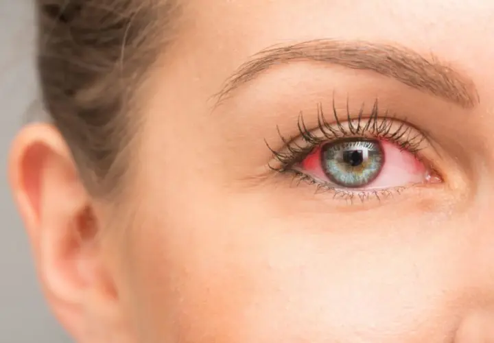 Occhio con congiuntiva arrossata e irritata, sintomo di secchezza oculare.