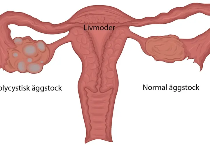Illustration av livmoder med en normal äggstock och en polycystisk äggstock, en vanlig pcos symptom.