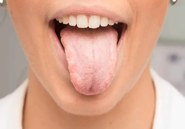 Boca abierta mostrando lengua rosada y blanca, con posible acidez en la boca y lengua.