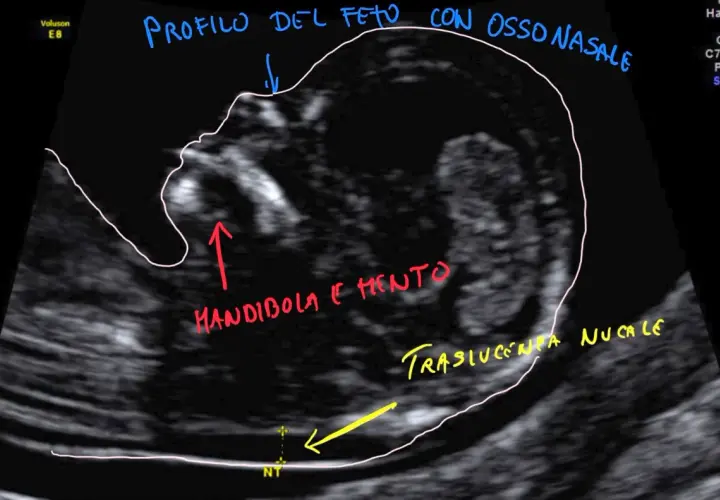 Profilo fetale con osso nasale, mandibola e mento visibili. Misurazione traslucenza nucale (NT) per bi test.