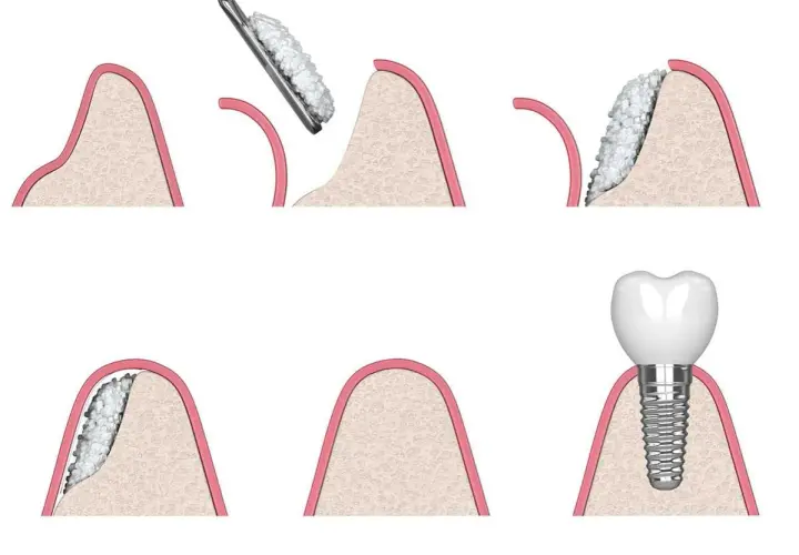 Illustrazione delle fasi di un innesto osseo dentale: preparazione, aggiunta di materiale osseo e inserimento dell'impianto.