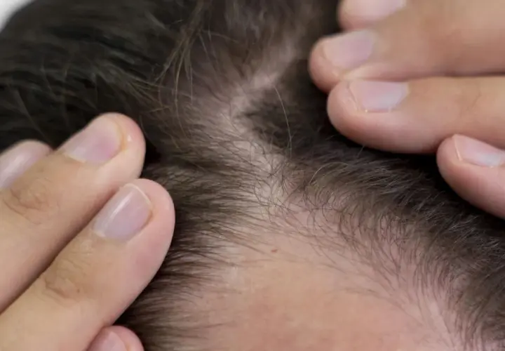 Manos revisando el cuero cabelludo, observando el ciclo cabello y su posible debilitamiento.