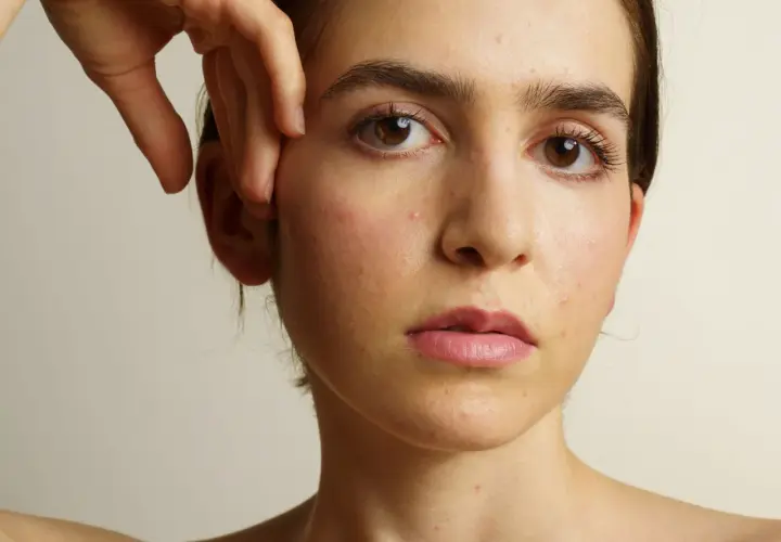 Visage d'une jeune femme aux yeux marron, présentant des rougeurs et des imperfections cutanées, évoquant l'acné et la ménopause.