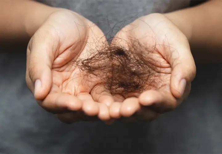 Manos sostienen un puñado de cabello suelto, un signo visible de efluvio telógeno crónico.