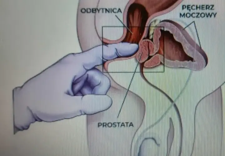 Anatomical illustration showing a gloved finger performing a prostate massage through the rectum.
