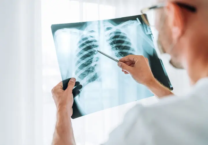 Medico esamina radiografia polmonare, evidenziando un caso di polmonite nosocomiale e valutando il potenziale risarcimento.