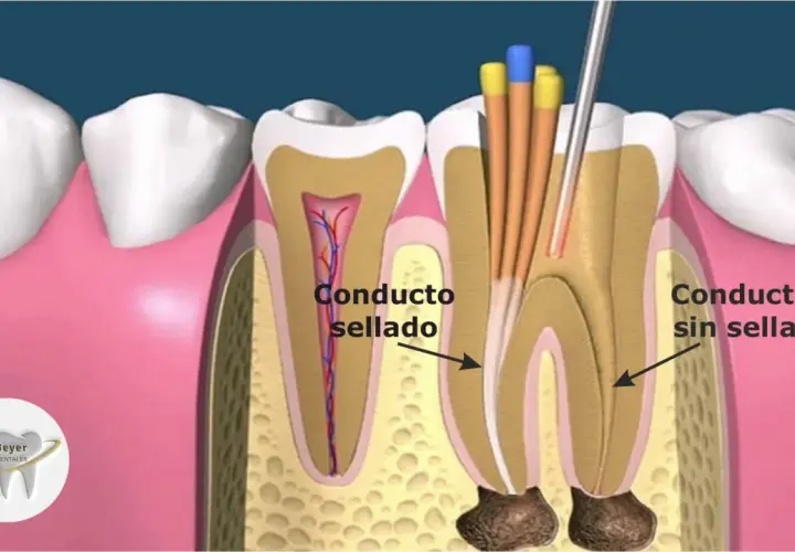 Ilustración de un diente mostrando un conducto radicular sellado y otro sin sellar, con instrumentos dentales. Esto explica qué es una reendodoncia.