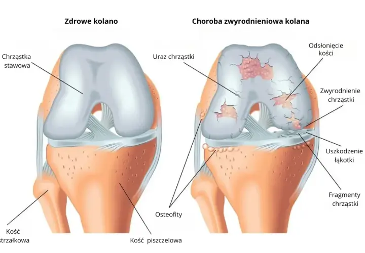 Porównanie zdrowego kolana z kolanem dotkniętym gonartrozą. Widać uszkodzenia chrząstki, odsłonięte kości i osteofity.