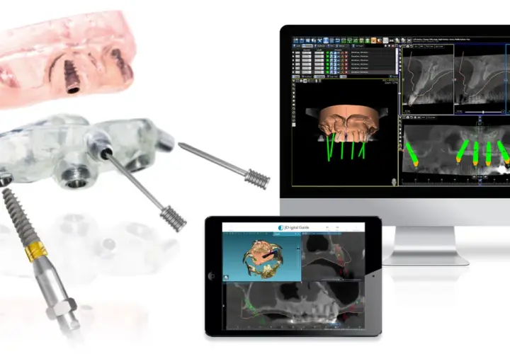 Componenti per chirurgia guidata dentale: guide, impianti e software di pianificazione 3D.