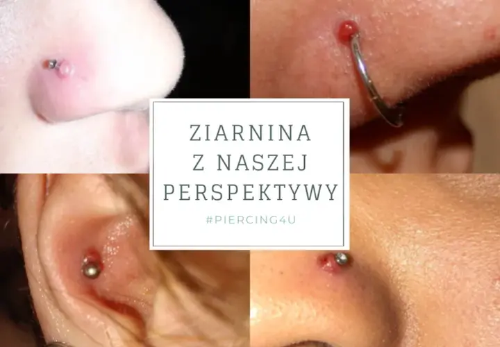 Infekcja kolczyka w pępku: Jak rozpoznać objawy i skutecznie leczyć?