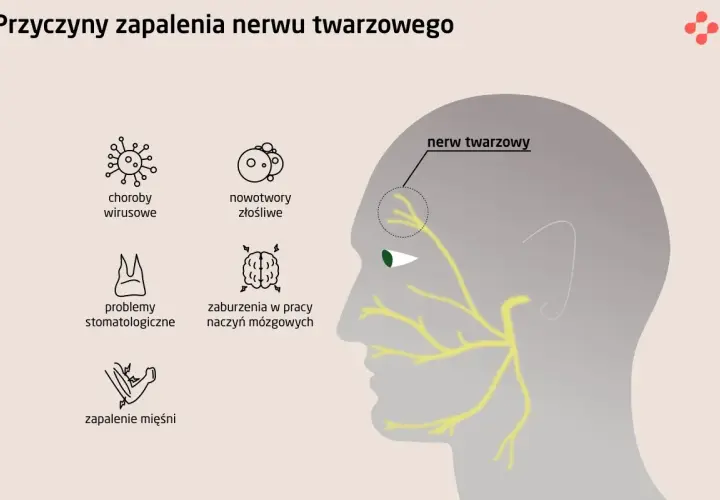 Ilustracja przedstawia schematyczne przyczyny zapalenia nerwu twarzowego: choroby wirusowe, nowotwory, problemy stomatologiczne, zaburzenia naczyń mózgowych i zapalenie mięśni.