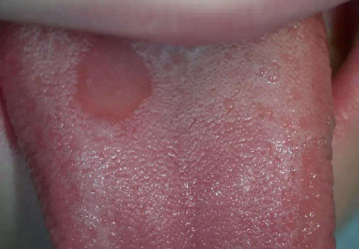 Lingua con afte, un sintomo comune nella celiachia. Le papille gustative appaiono gonfie e irritate.