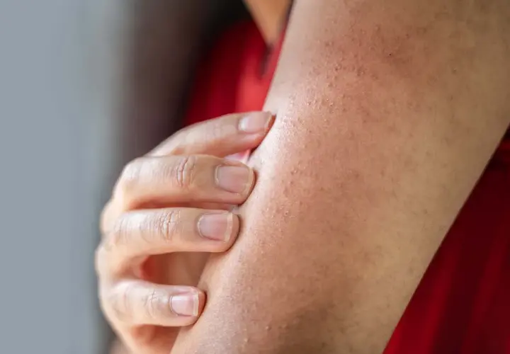 En hand undersöker en arm med en knottrig panna, troligen ett utslag eller torr hud.