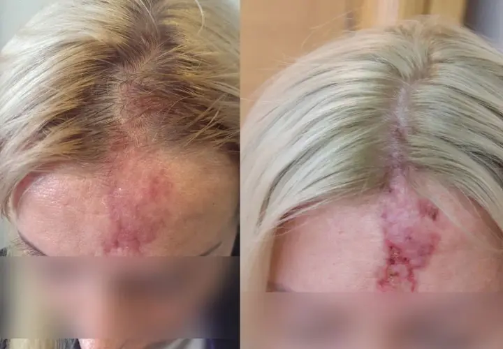 Skutki uboczne kwasu hialuronowego – co powinieneś wiedzieć przed zabiegiem?