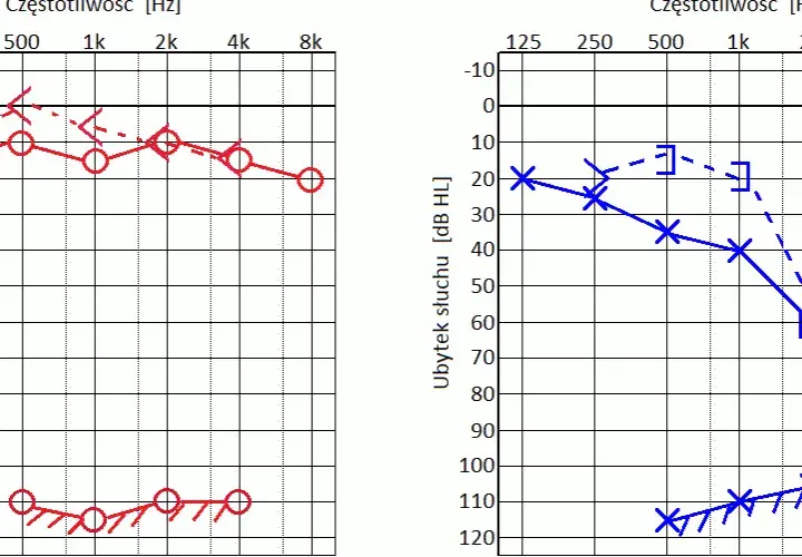 Audiogram - jak wygląda badanie słuchu i ile faktycznie trwa u specjalisty