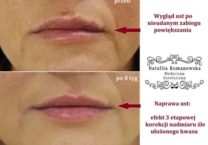 Czy można się całować po powiększaniu ust? Dowiedz się, co musisz wiedzieć