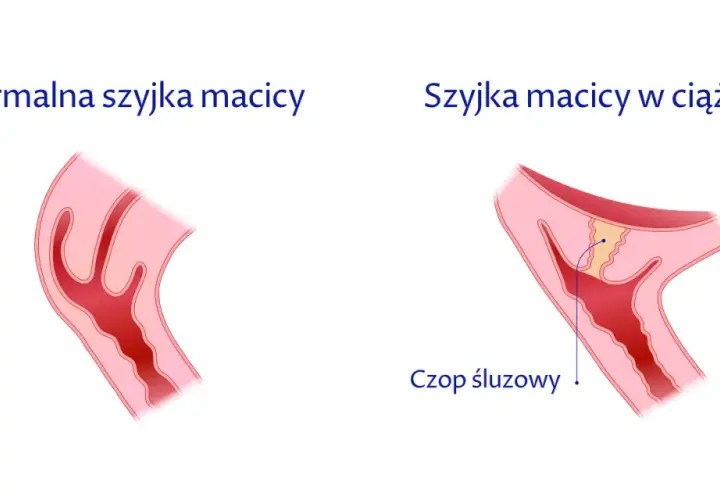 Jak skutecznie zapobiec skracaniu szyjki macicy w ciąży i uniknąć zagrożeń