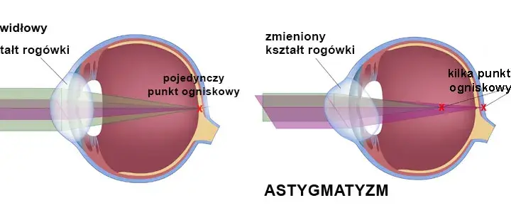 Czy można wyleczyć minusową wadę wzroku: fakty i skuteczne metody leczenia