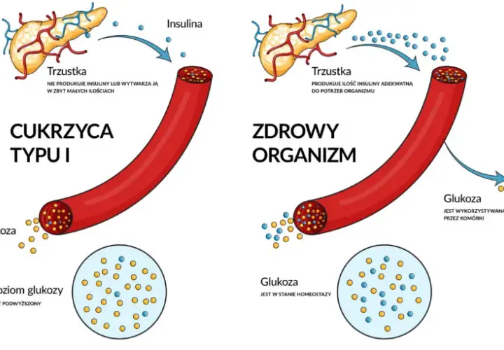 Skąd się bierze cukrzyca? Poznaj zaskakujące przyczyny i czynniki ryzyka