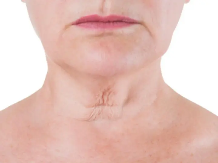 Primer plano del cuello de una mujer, mostrando arrugas en el cuello y la piel con pecas.