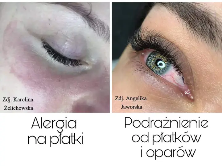 Alergia na rzęsy: objawy, kiedy występuje i co robić?