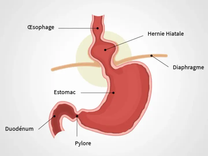 Schéma du diaphragme et de l'estomac montrant une hernie hiatale. Des remèdes de grand-mère peuvent aider à soulager les symptômes.