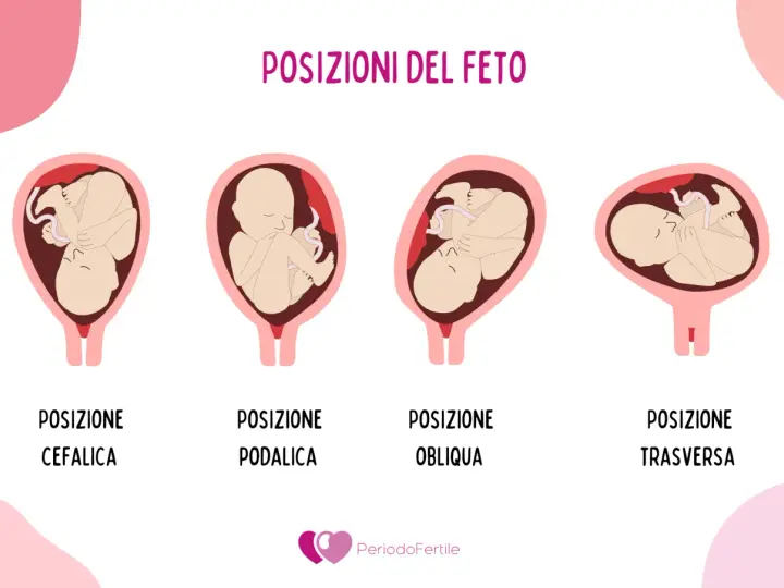 Illustrazione mostra le posizioni del feto: cefalica, podalica, obliqua e trasversa. La posizione podalica è quella in cui il bambino è seduto, con i piedi verso il basso.