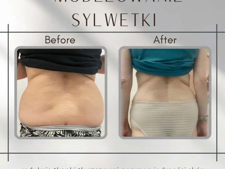 Liposukcja: Modelowanie sylwetki i trwałe efekty. Czy to dla Ciebie?