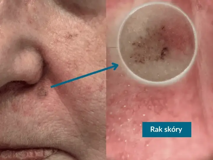 Niepokojący pieprzyk na nosie, powiększony dermatoskopem, ujawnia zmiany sugerujące raka skóry.
