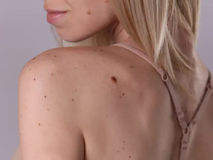 Schulter und Nacken einer Frau mit vielen braunen und schwarzen Flecken auf der Haut.