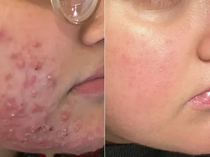Före- och efterbilder visar en ansiktshud med atopiskt eksem som blivit betydligt bättre.