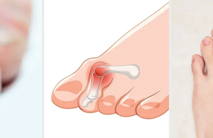 Pie con juanete y uñas afectadas, resultado de usar zapatos estrechos en la parte delantera.
