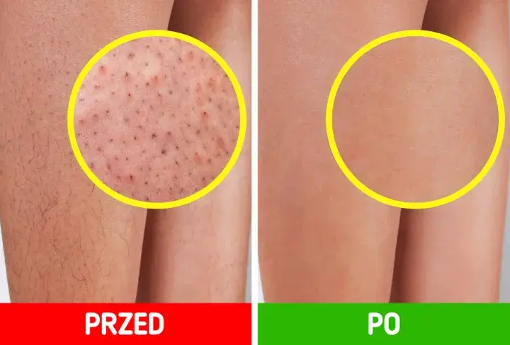 Jak pożegnać „truskawkowe nogi”? Gładka skóra po goleniu!