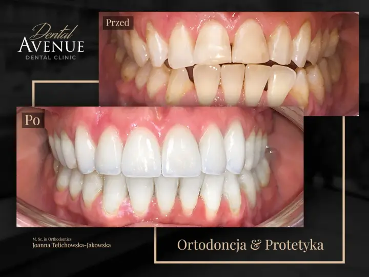 Przed i po leczeniu ortodontycznym: zęby przed aparatem były nierówne i przebarwione, a po zdjęciu aparatu są proste i białe.