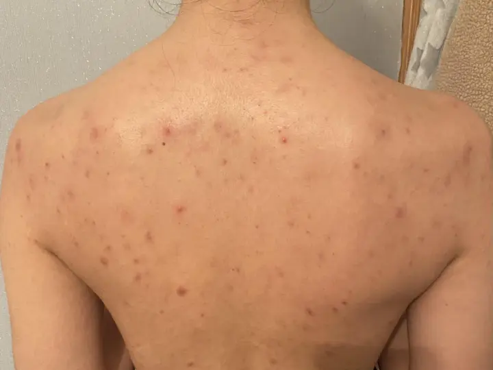 Rygg med utslag av akne på kroppen. Röda prickar och fläckar syns över hela ryggen.