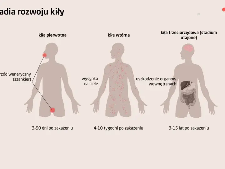 Ilustracja przedstawia stadia rozwoju kiły: pierwotna (wrzód), wtórna (wysypka skórna) i trzeciorzędowa (uszkodzenia narządów).