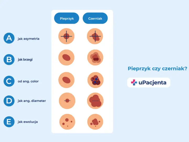 Porównanie pieprzyka i czerniaka: asymetria, brzegi, kolor, średnica i ewolucja. Jak wygląda czerniak skóry?