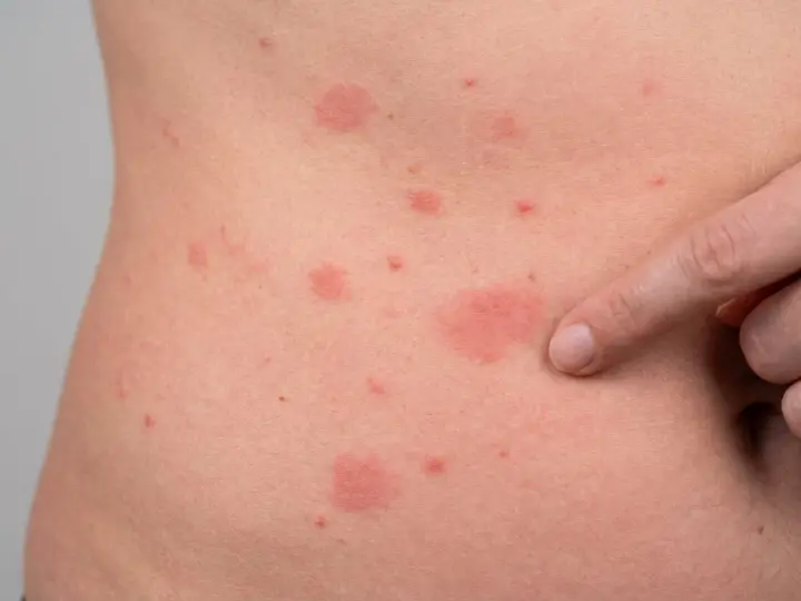 Rote Flecken und Quaddeln auf der Haut, ein deutlicher **ausschlag am bauch**. Ein Finger deutet auf eine der betroffenen Stellen.