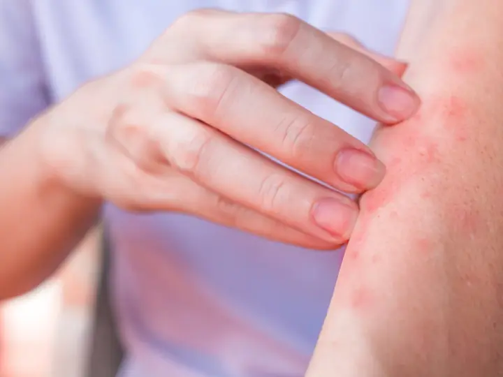 Dito, un braccio con eruzione cutanea rossa e pruriginosa, sintomo di un'allergia al nichel.