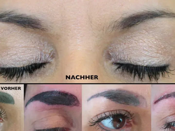 PMU entfernen: Was Sie über Laser, Remover & Kosten wissen müssen