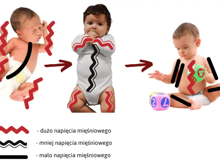 Dziecko sie napina, od noworodka z dużym napięciem, przez niemowlę z mniejszym, do starszego dziecka z minimalnym napięciem.