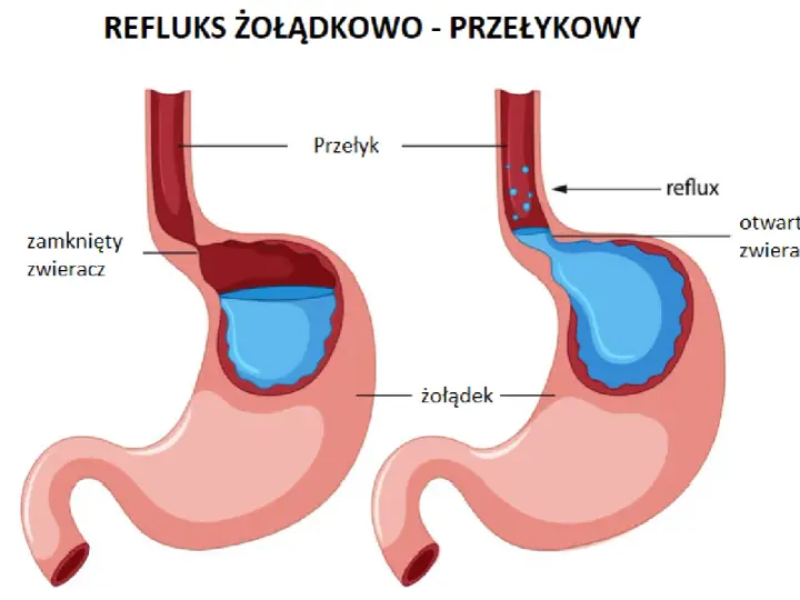 Ilustracja pokazuje refluks żołądkowo-przełykowy. Po lewej zamknięty zwieracz, po prawej otwarty, powodujący cofanie się treści żołądkowej do przełyku. Kawa może nasilać ten problem.