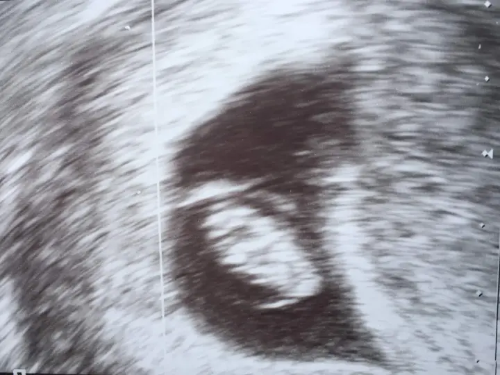 Ultraschallbild zeigt einen frühen Embryo. Die Ramzi-Methode könnte hier angewendet werden, um das Geschlecht zu erraten.