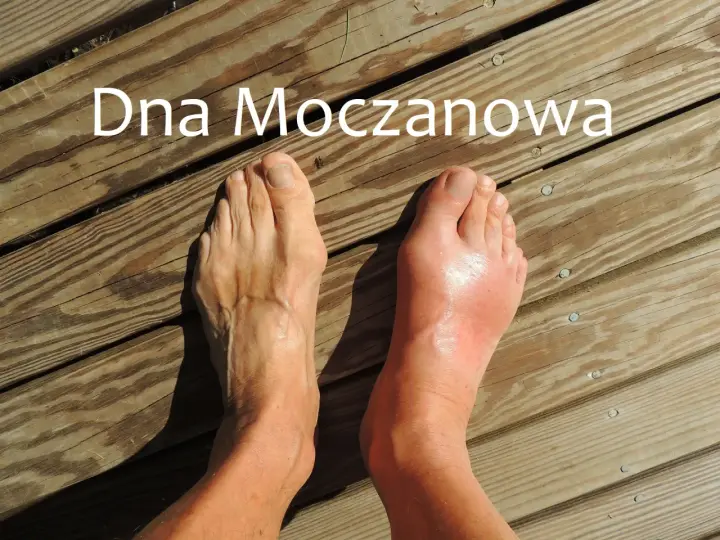 Dna moczanowa: obrzęknięty, czerwony paluch stopy po prawej, zdrowa stopa po lewej. Przyczyny tej choroby mogą być różne.