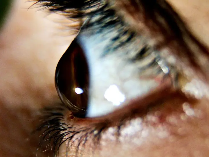 Occhio umano con riflessi luminosi. Il cheratocono è ereditario, una condizione che può colpire la vista.