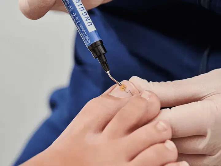 Jak zerwać paznokieć bez bólu? Skuteczne metody i porady
